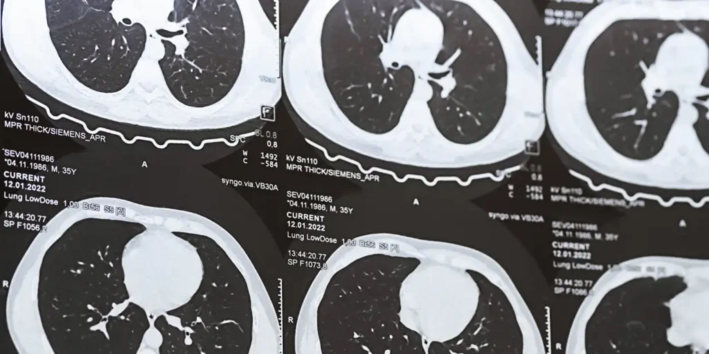 Adjuvant osimertinib reduced the risk of death by 47% at eight years in ADAURA